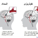روز جهانی سکته مغزی؛ اصلی‌ترین عاملِ خطر در همه کشورها