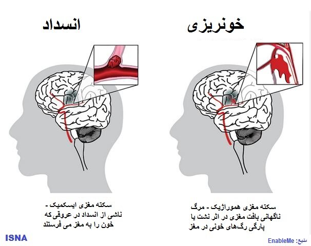 روز جهانی سکته مغزی؛ اصلی‌ترین عاملِ خطر در همه کشورها