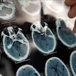 هشدار درباره شروع آلزایمر از ۴۰ سالگی/ عوامل مؤثر در پیشگیری از آلزایمر