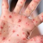 حذف سرخک و سرخجه در ایران/تبریک مدیر منطقه‌ای سازمان جهانی بهداشت به وزیر بهداشت