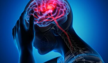 روزانه ۲۰۰ تهرانی دچار این عارضه میشوند روزانه ۲۰۰ تهرانی دچار این عارضه میشوند