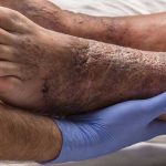 ۱۵ درصد دیابتی‌ها دچار زخم دیابت می‌شوند