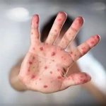 گزارش جدید سازمان جهانی بهداشت از شیوع سرخک