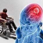 علائم رایج ام‌اس در خانم‌ها و آقایان