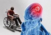 علائم رایج ام‌اس در خانم‌ها و آقایان