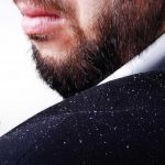 به جنگ با شوره سر با روش های ساده بروید!