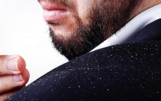 به جنگ با شوره سر با روش های ساده بروید!