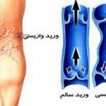 چه کسانی بیشتر واریس می گیرند؟