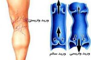 چه کسانی بیشتر واریس می گیرند؟
