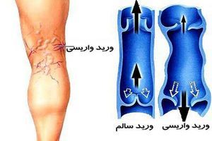 چه کسانی بیشتر واریس می گیرند؟