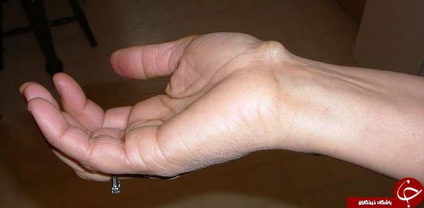 کیست مچ دست و ترفند‌هایی سنتی برای درمان آن